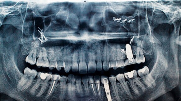 Tooth implant x-ray