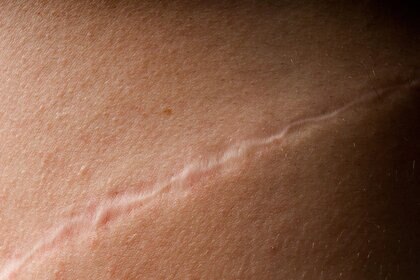 Close-up of a scar on a persons skin