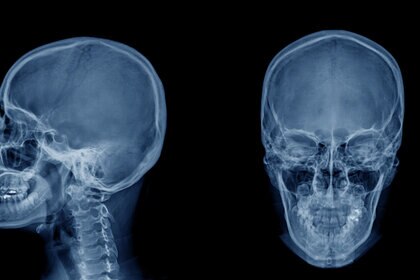 Close-Up X-Ray Of Human Head