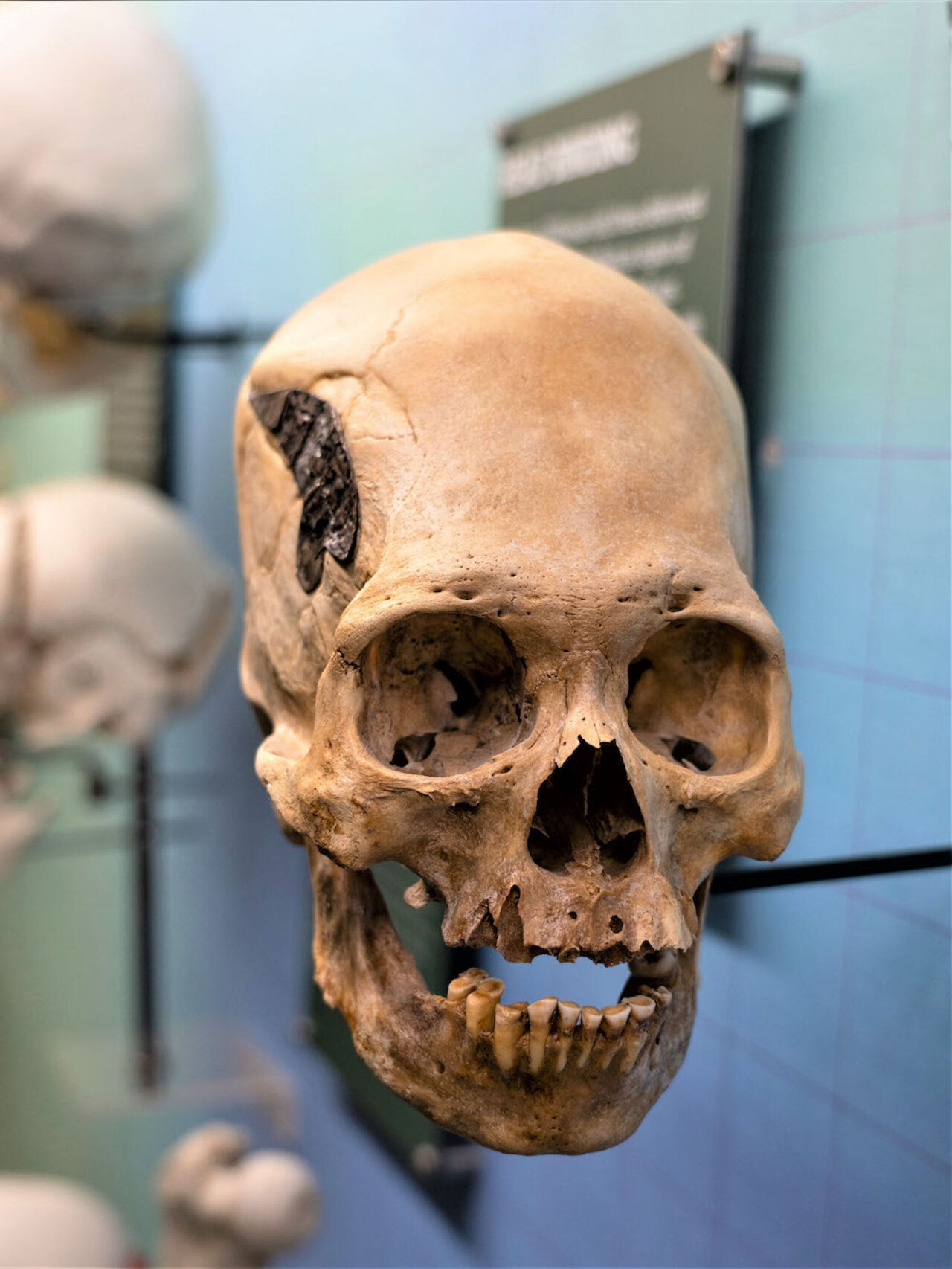 Ancient Peruvian skull with metal implant baffles scientists