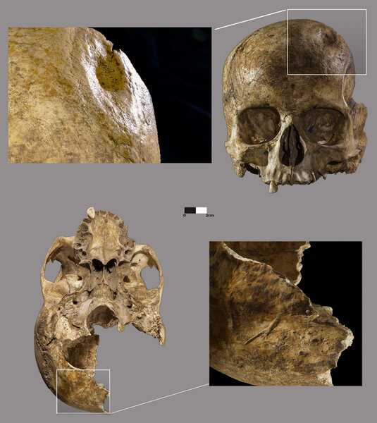 skull with evidence of trepanation