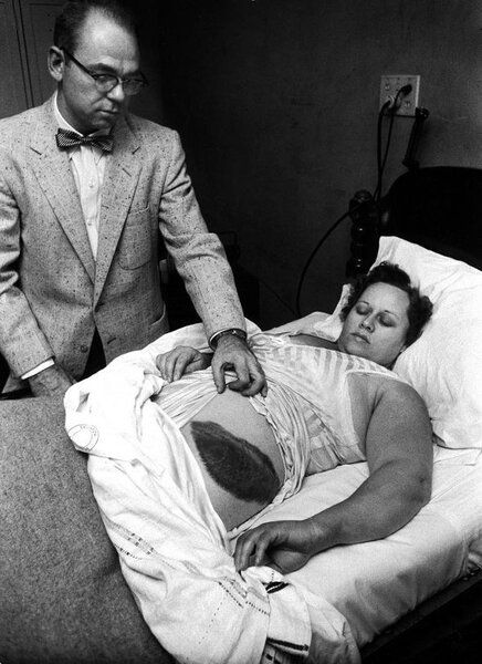 Anne Hodges was struck by a meteorite in 1954, leaving a huge bruise. Credit: Jay Leviton, Time & Life Pictures/Getty Images