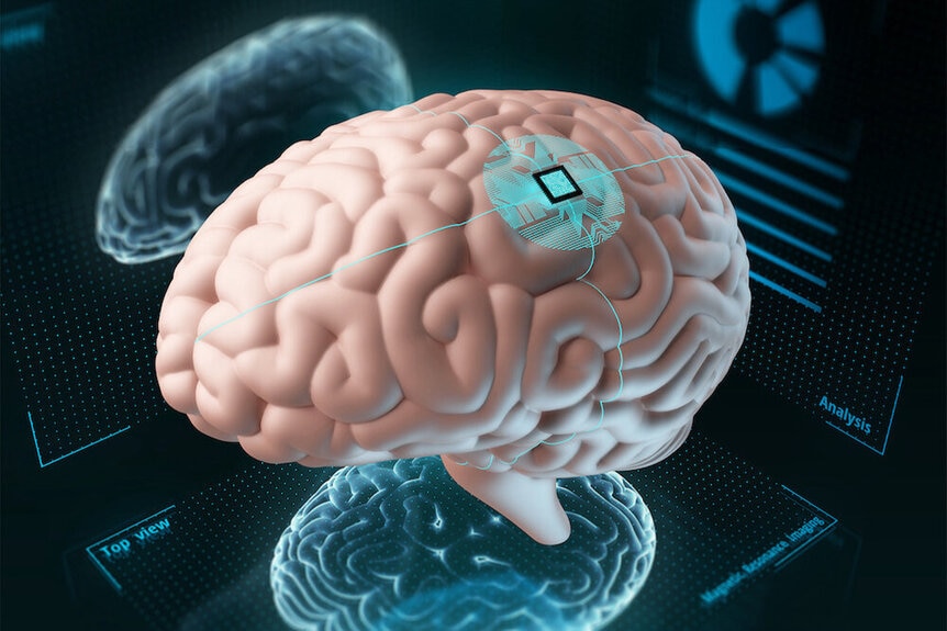 Chip implanted in human brain